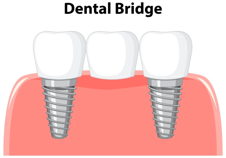 a dental crown and bridges implants in gums