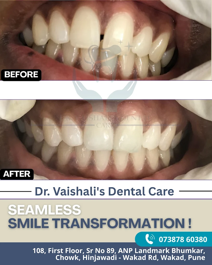 Teeth whitening in Wakad