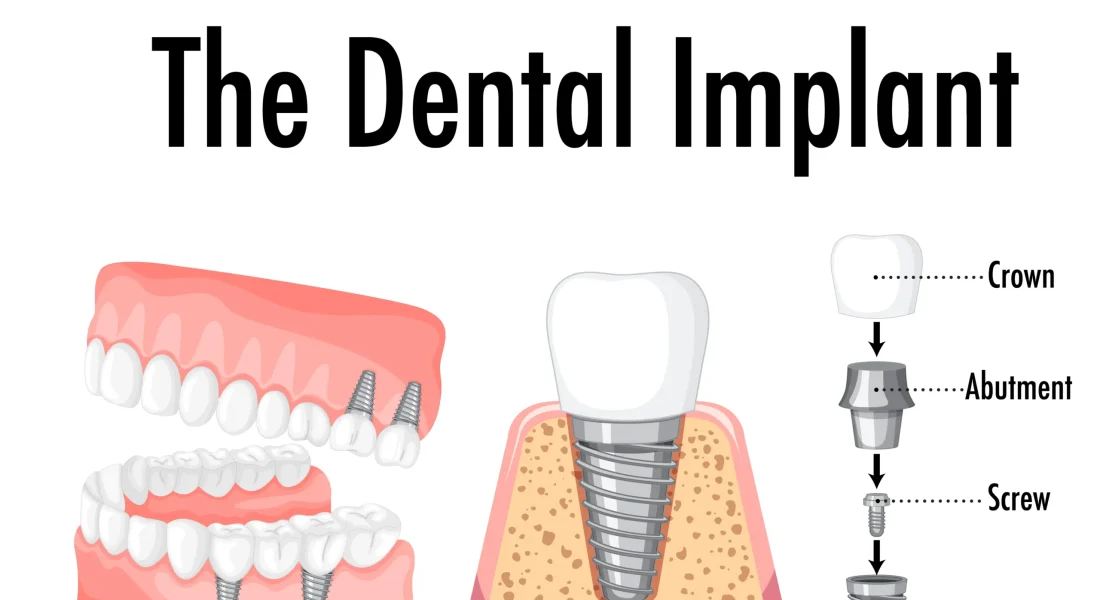 Dental Implant